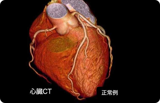 心臓CT（冠動脈CT）の画像