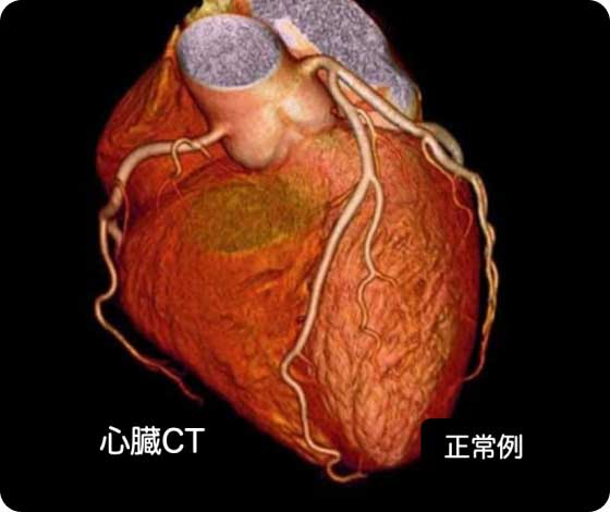 心臓CT（冠動脈CT）の画像